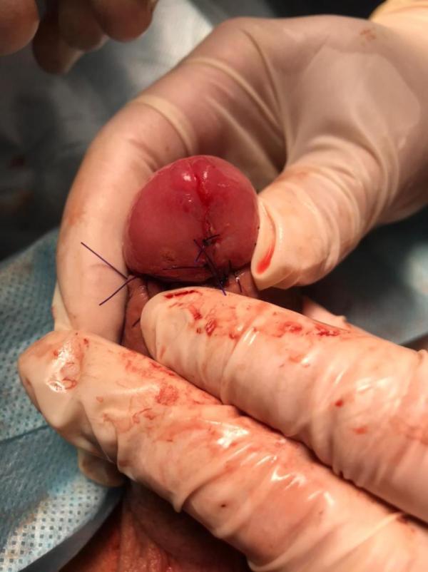 операция на половом члене