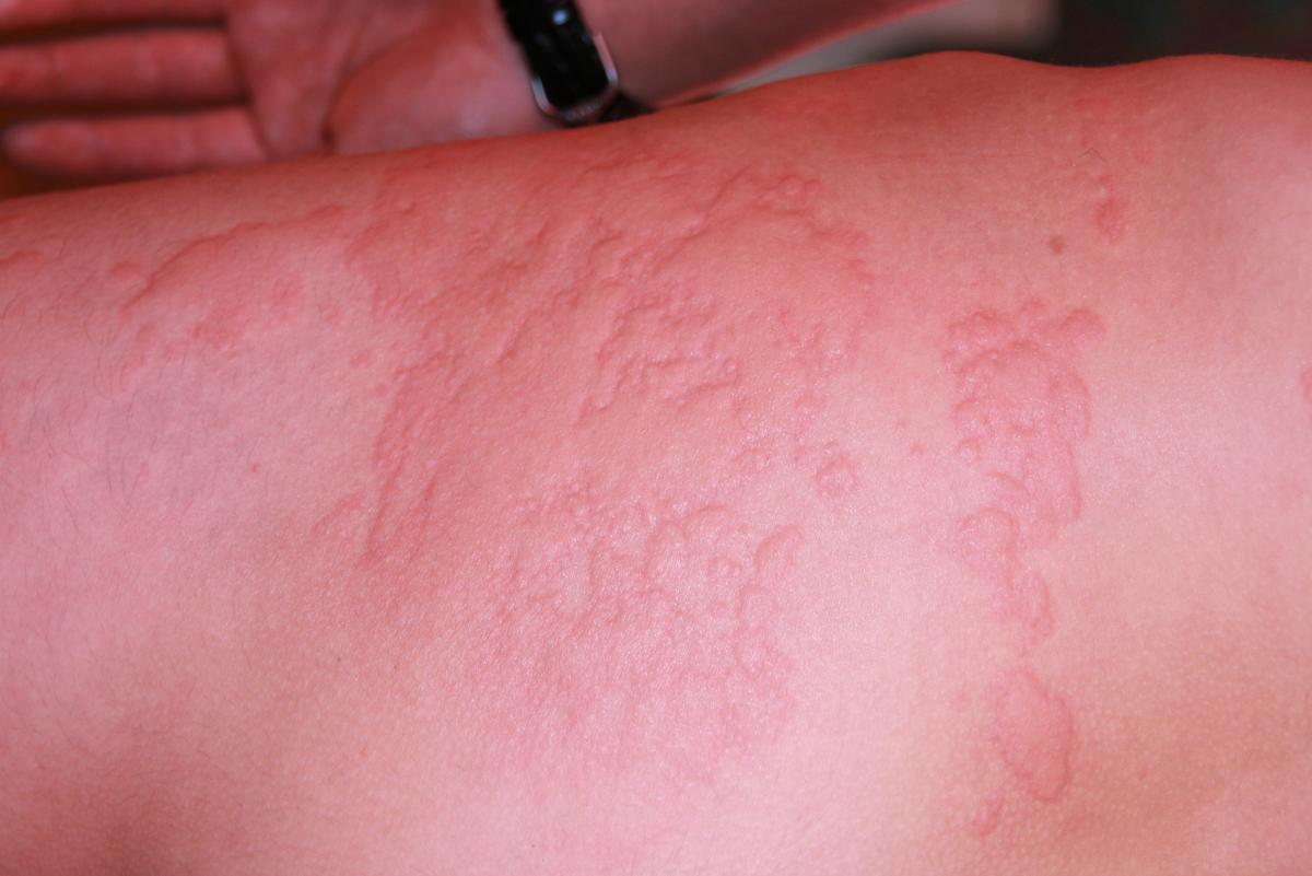 Крапивница 