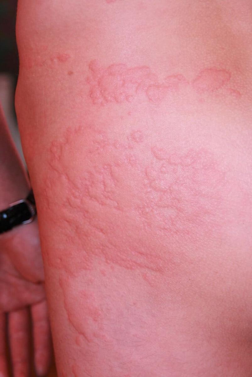 крапивница