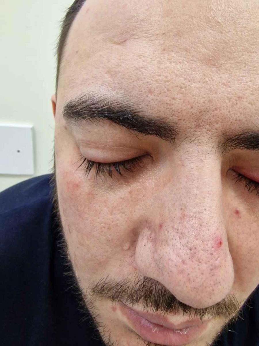 обычный конъюнктивит обычный конъюнктивит