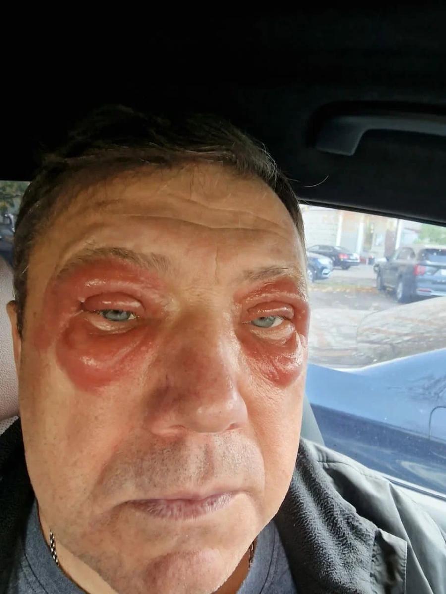 Отек глаз и шеи Отек глаз и шеи