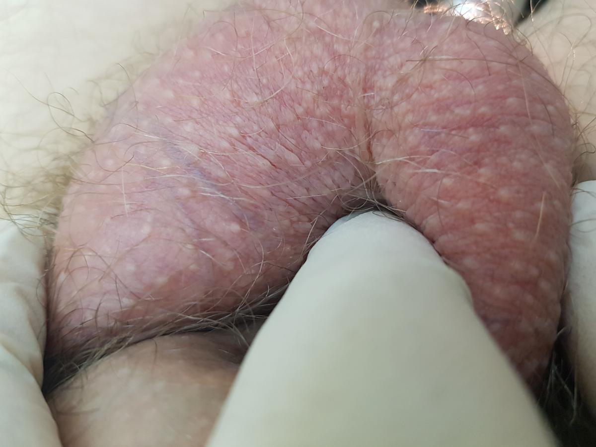 боль и воспаление в левом яичке Боль в левом яичке