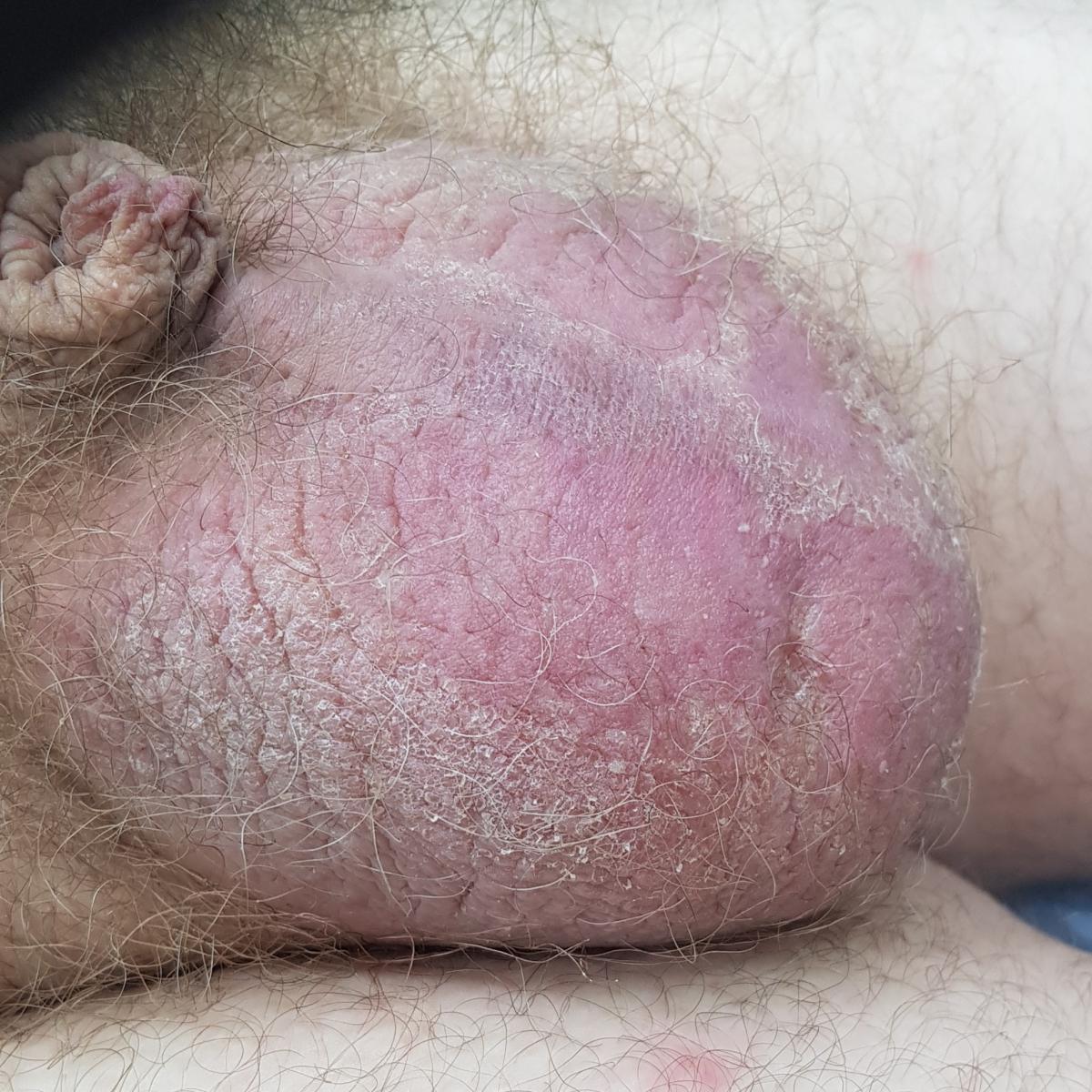 отек мошонки при сифилисе отек мошонки при сифилисе