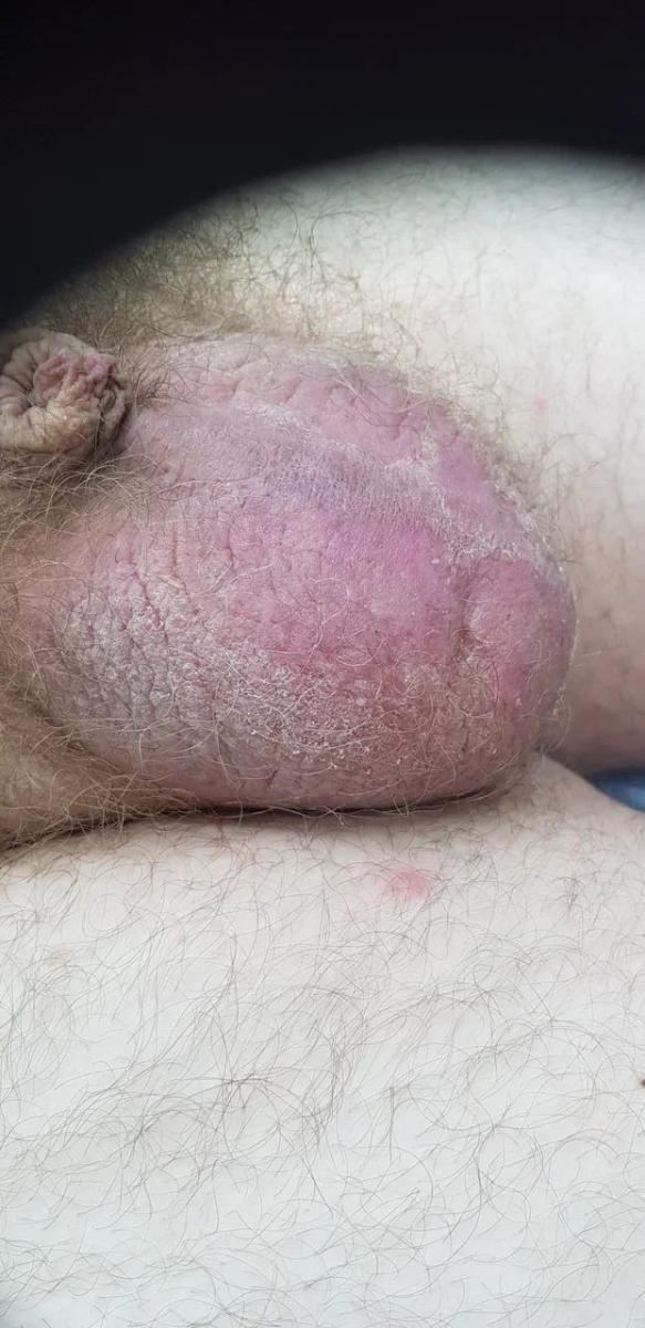 боли в промежности