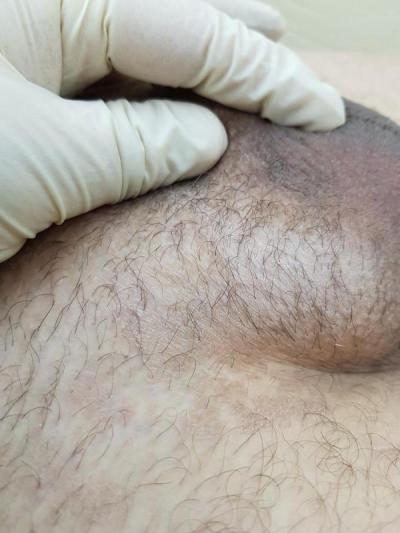 Лишай в паху лишай