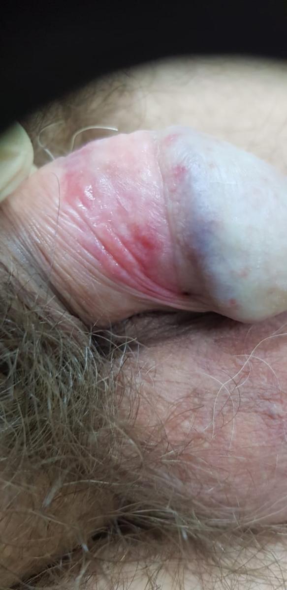 после лечения