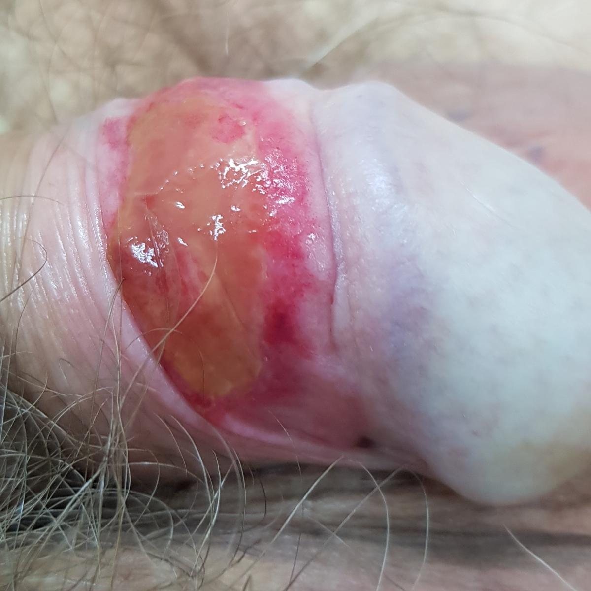 ожог на члене ожог на члене