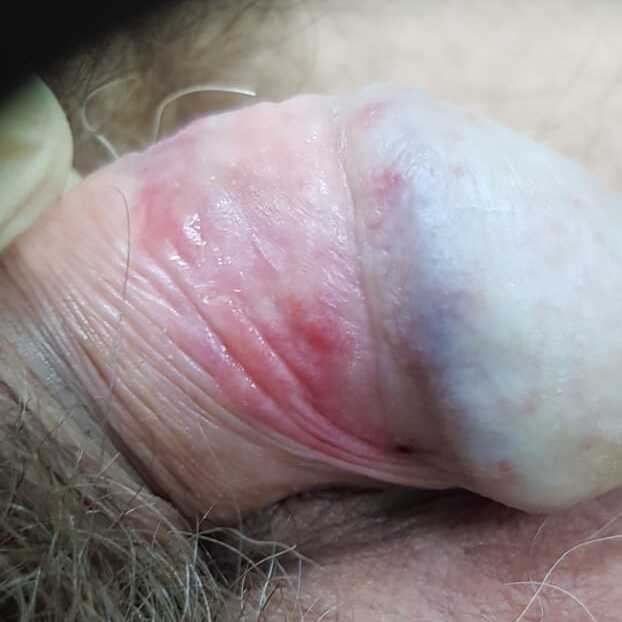 следы от ожога на члене следы от ожога на члене после лечения