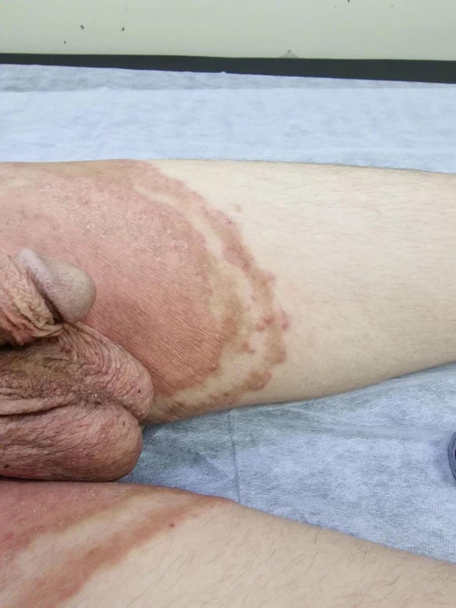 Паховая эпидермофития