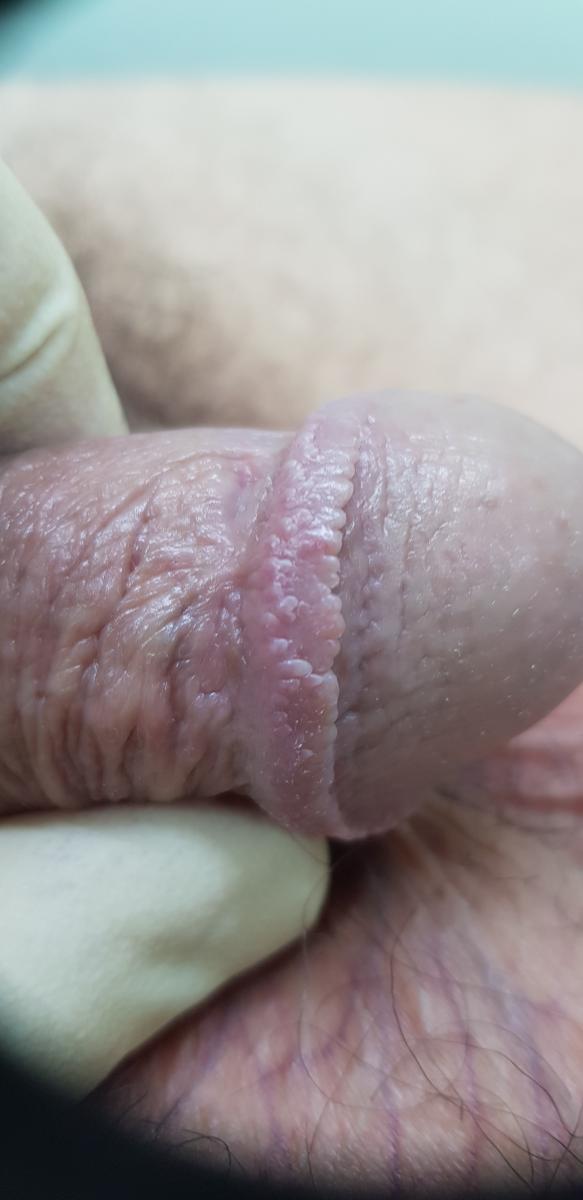 перламутровые папулы папулы