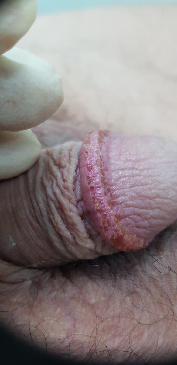 папулы удалены Сургитроном папулы