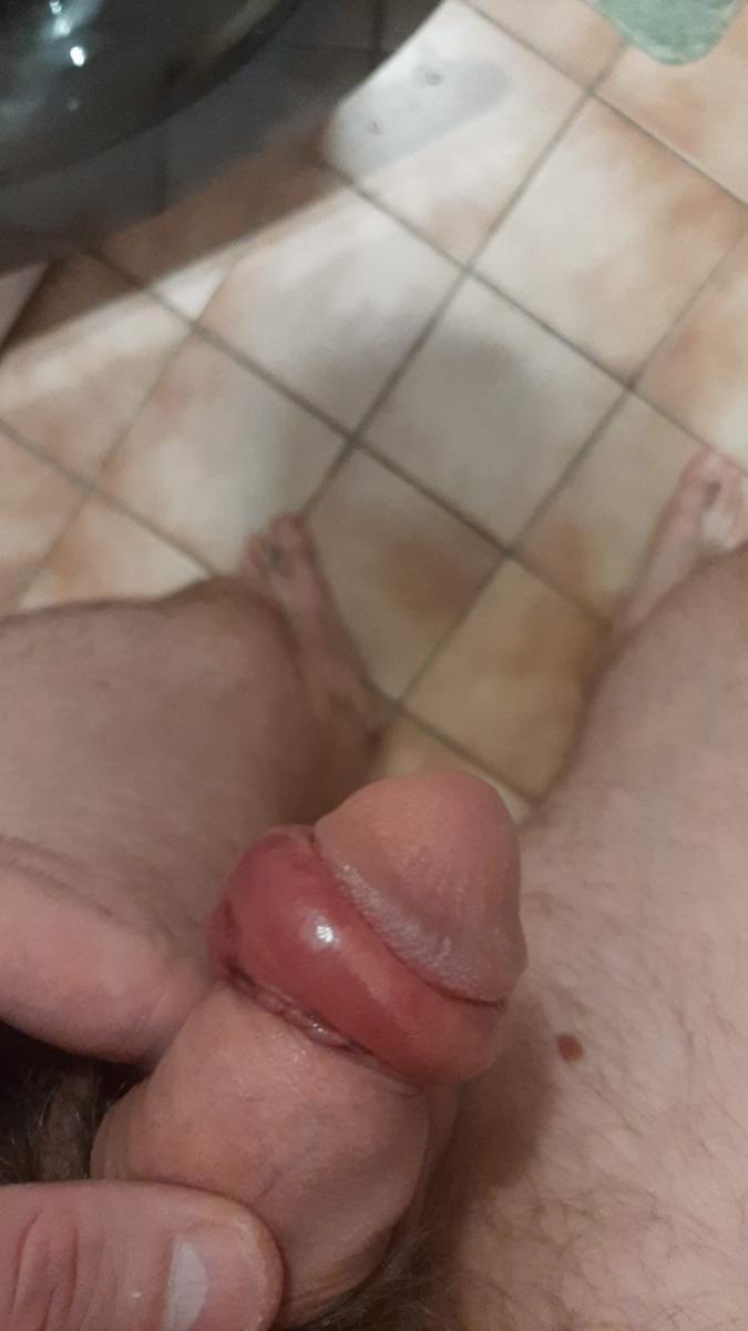 парафимоз, ущемление головки Парафимоз