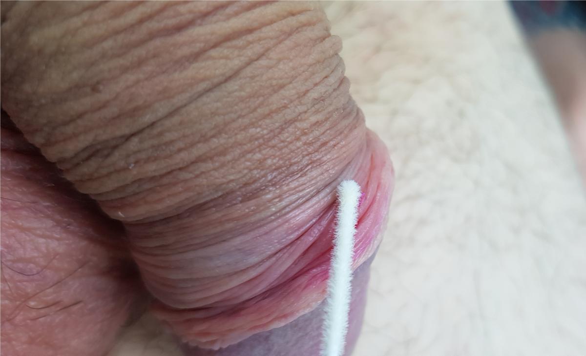 Микрошанкр Первичный микрошанкр