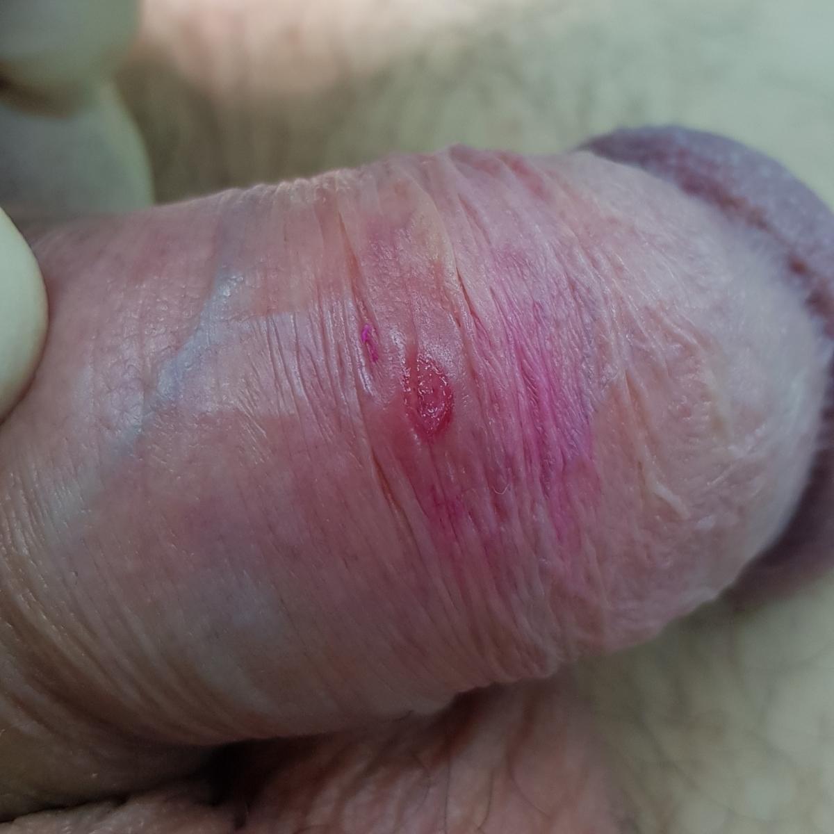 сифилис на члене первичный микрошанкр