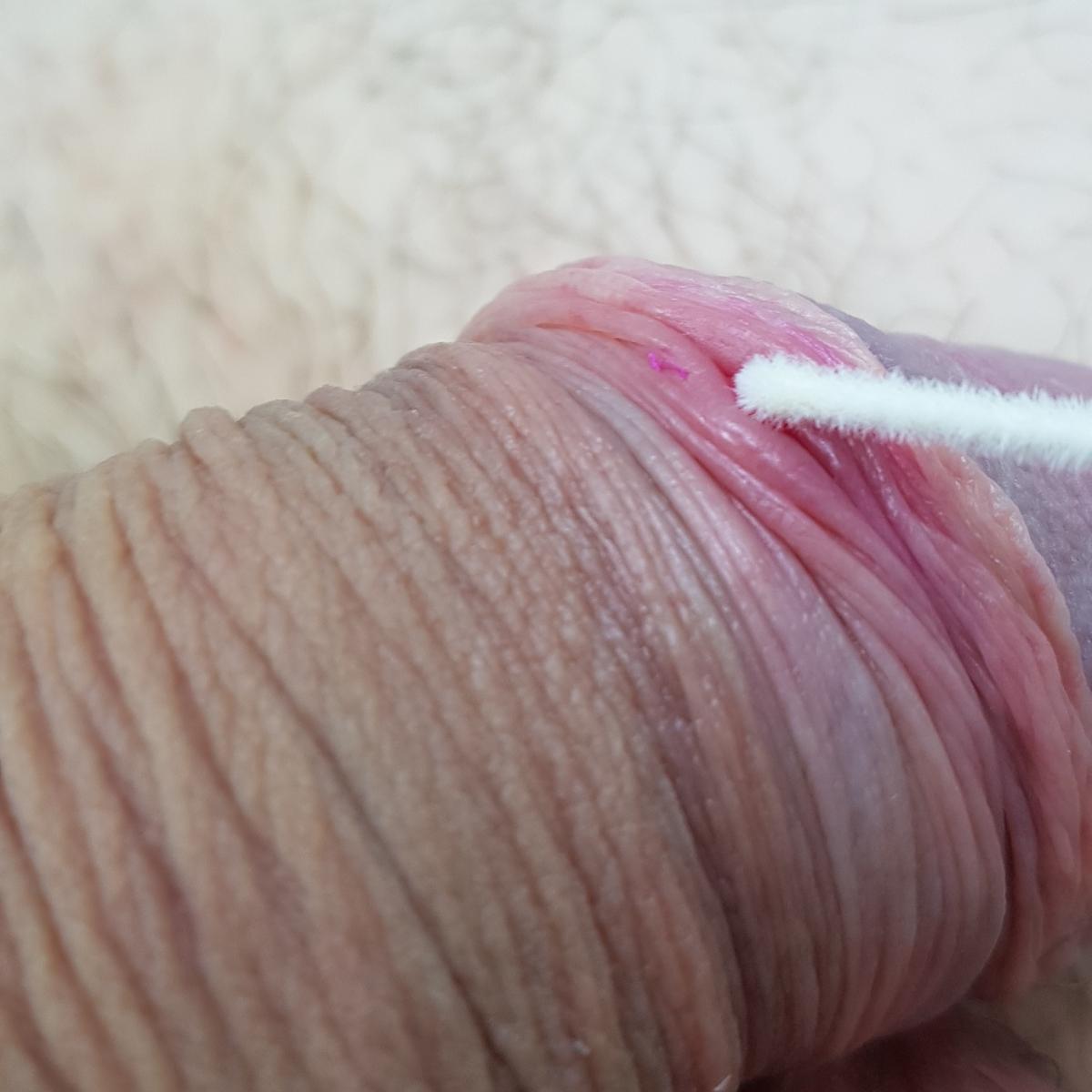 взятие мазка на сифилис мазок на сифилис