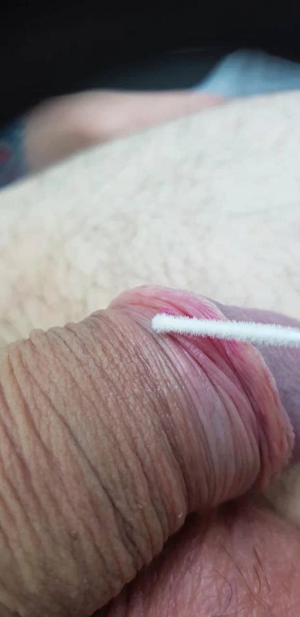 первичный микрошанкр на плоти