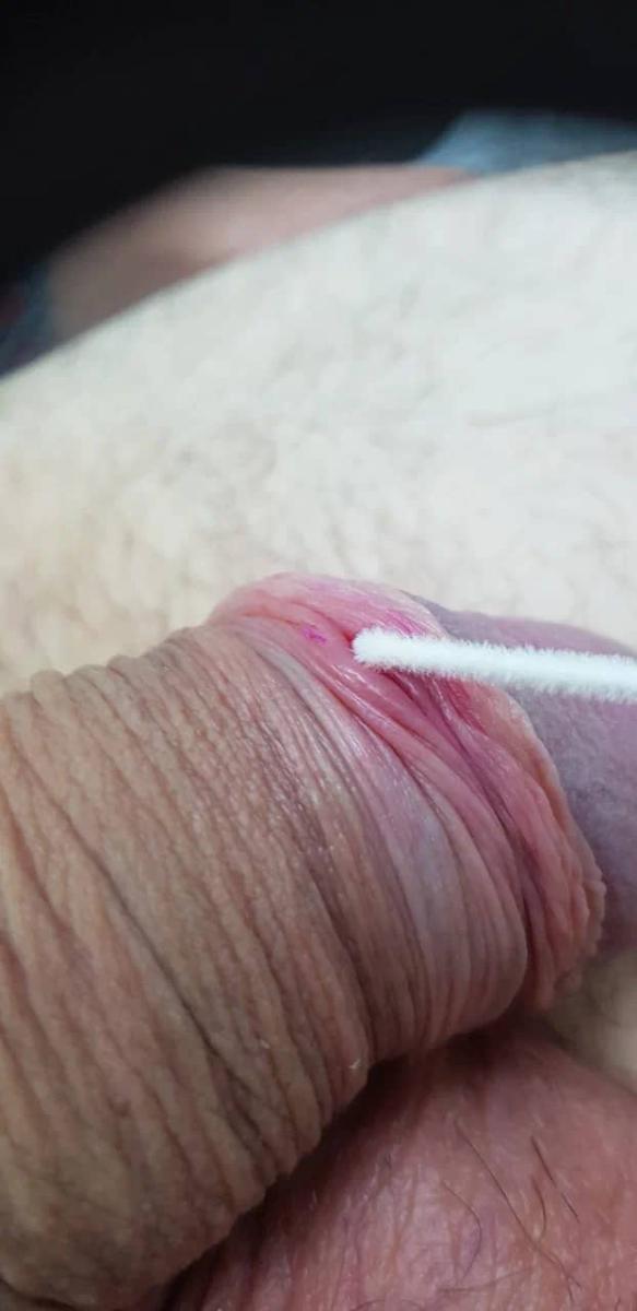 первичный микрошанкр первичный микрошанкр