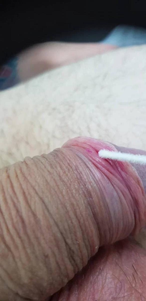 первичный микрошанкр