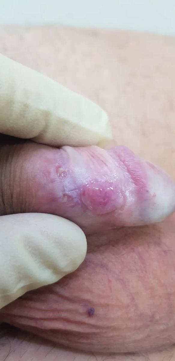 Первые симптомы сифилиса на члене