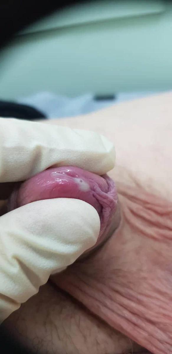 Пиелонефрит Пиелонефрит