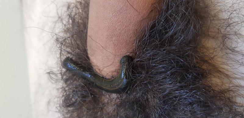 гирудотерапия при эрозивном баланопостите гирудотерапия