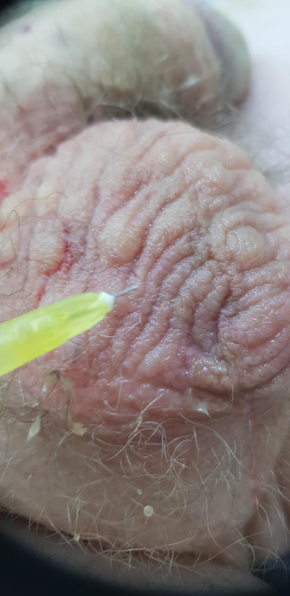 плазмолифтинг