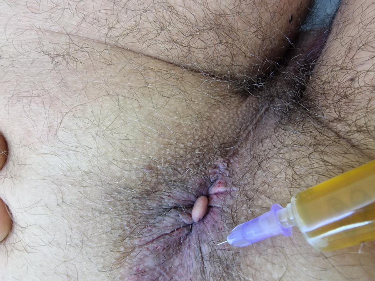 плазмалифтинг