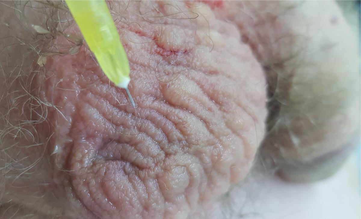 Плазмолифтинг мошонки Плазмолифтинг мошонки