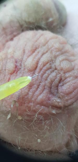 плазмолифтинг мошонки