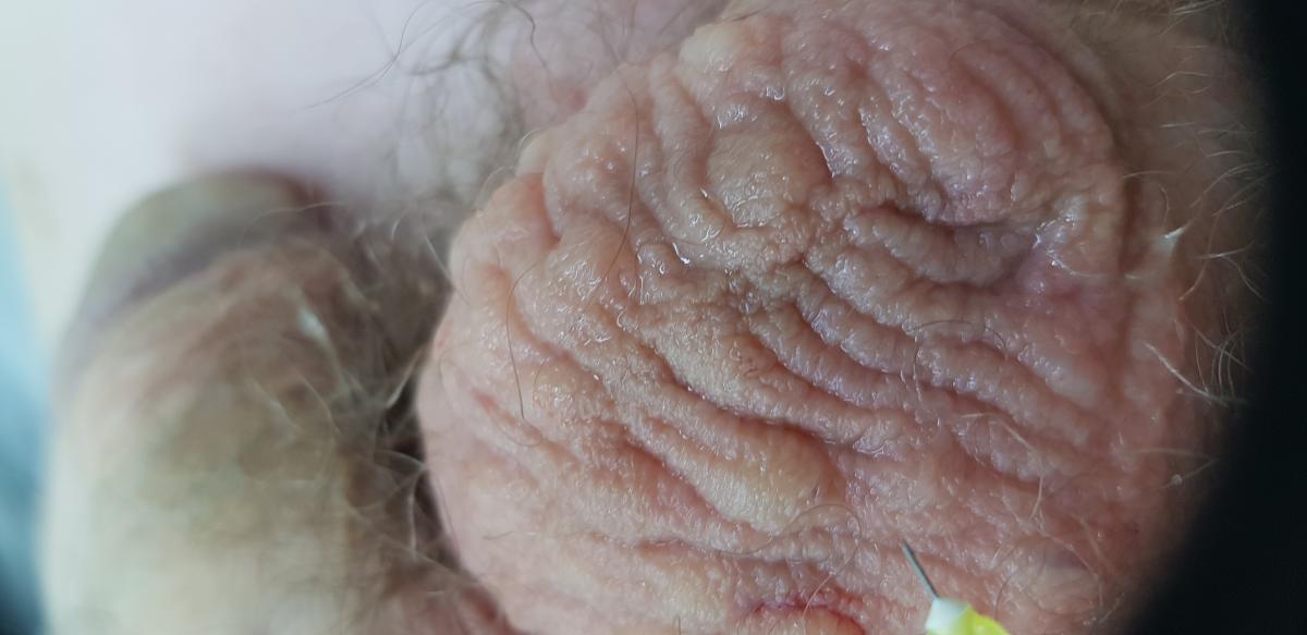 плазмолифтинг