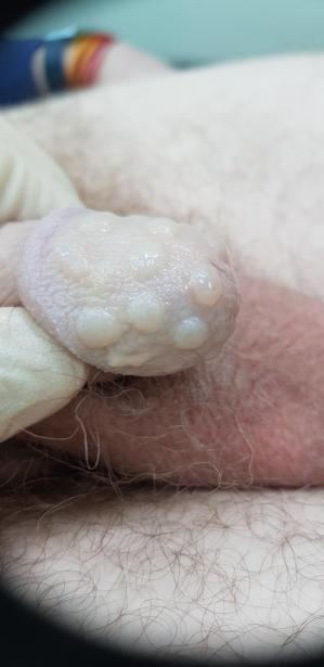 плазмолифтинг головки