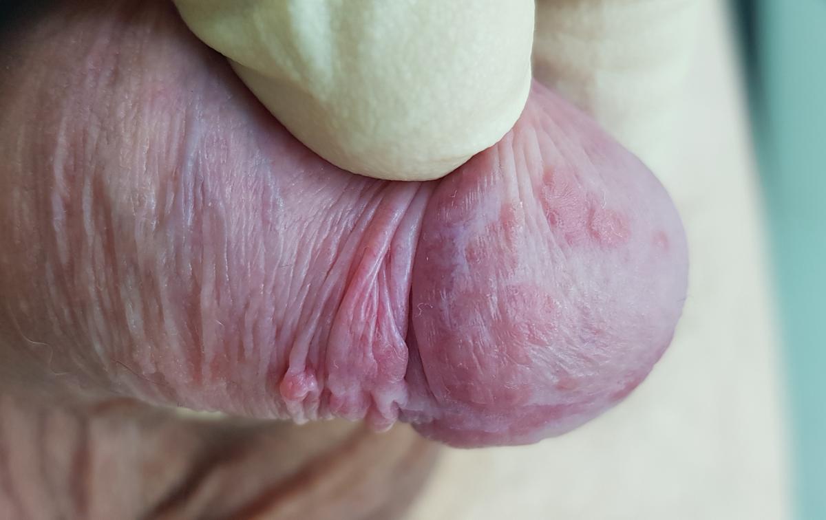 Плоские кондиломы на члене