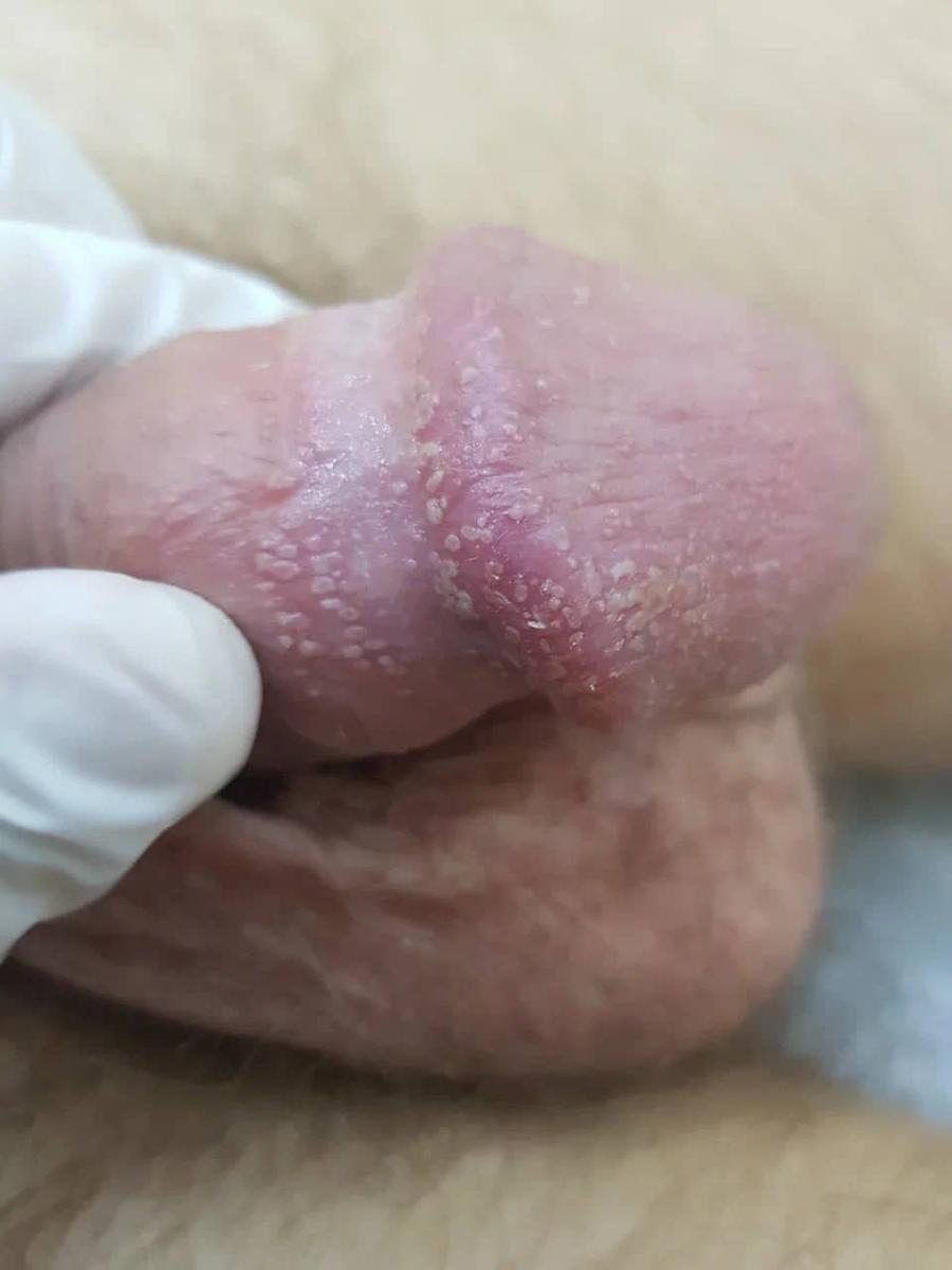 отслоение чешуек с поверхности кожи на головке отслоение чешуек с поверхности кожи на головке члена