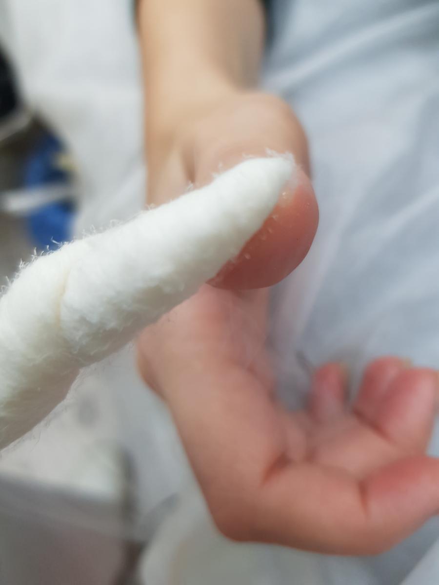 криодеструкция бородавки удаление папиллом жидким азотом