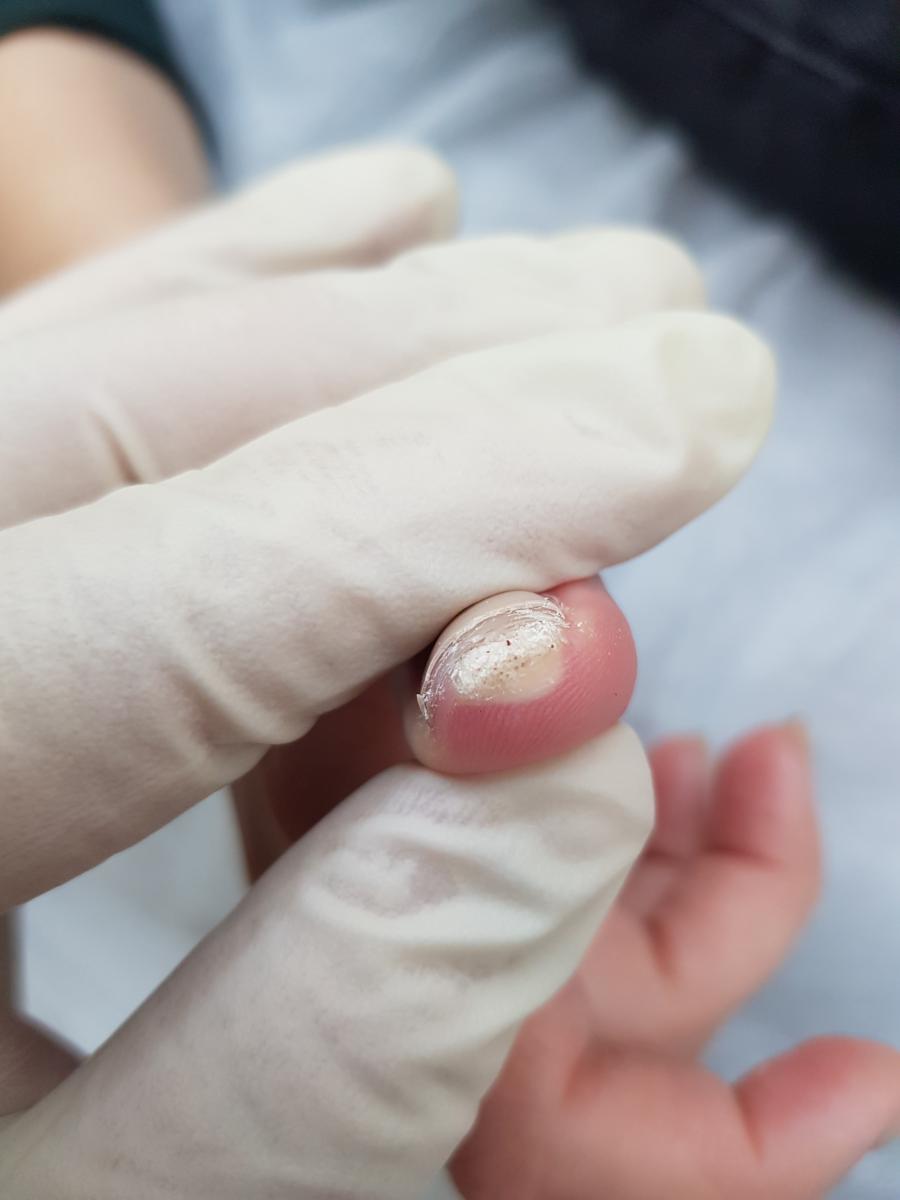 после криодеструкции бородавки удаление папиллом жидким азотом