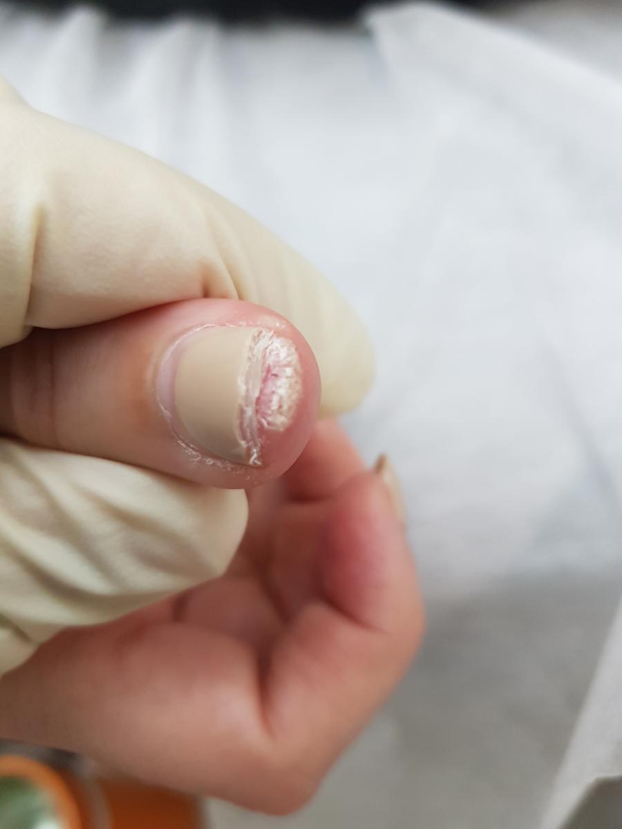 подногтевая бородавка до криодеструкции удаление папиллом жидким азотом