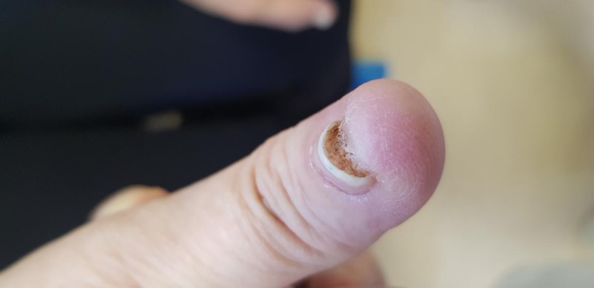 бородавки на рвках