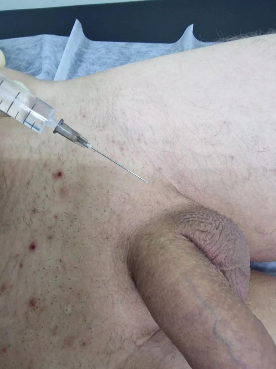 Лекарство для лечения сифилиса