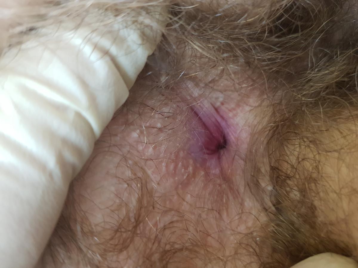 хламидийный проктит покраснение ануса