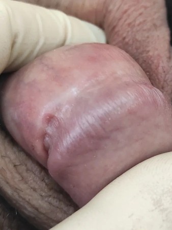 фото покраснение головки полового члена после вакцинации
