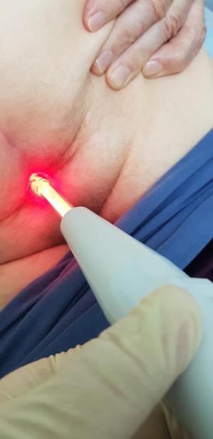 дарсонваль ануса при покраснении и зуде дарсонваль ануса