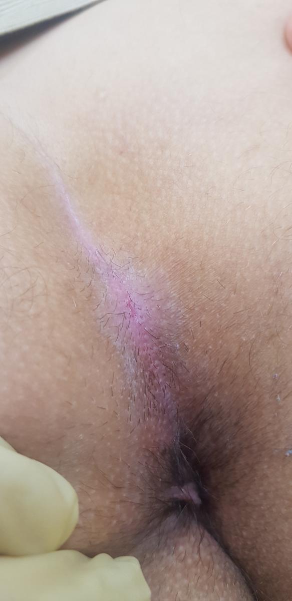 после 2х сеансов фотодинамической терапии фтд после 2 сеансов