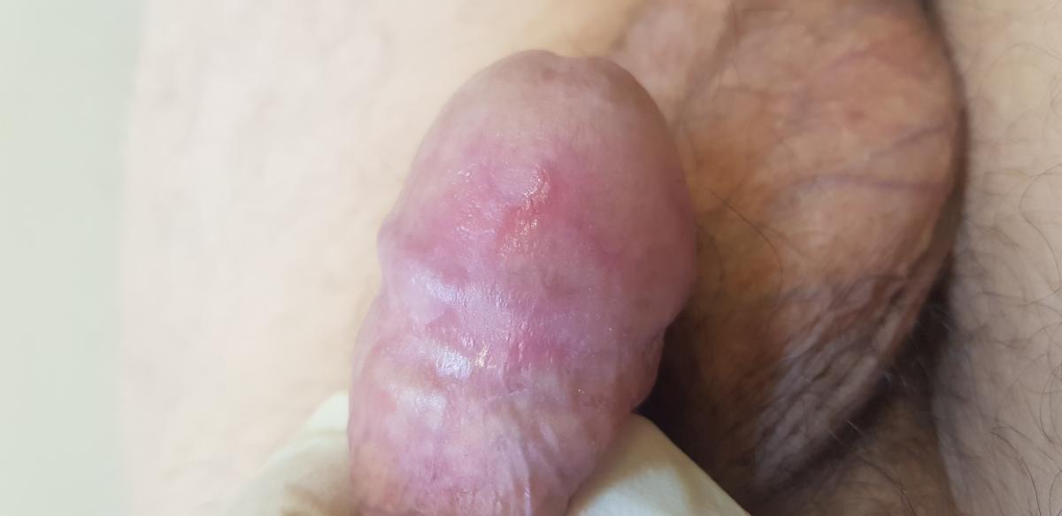 после лечения