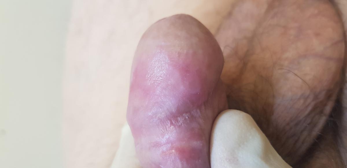 после лечения