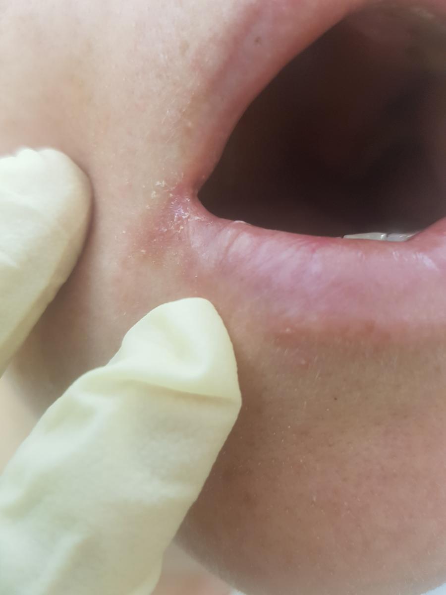 Анализ микробиоты слюны Анализ слюны