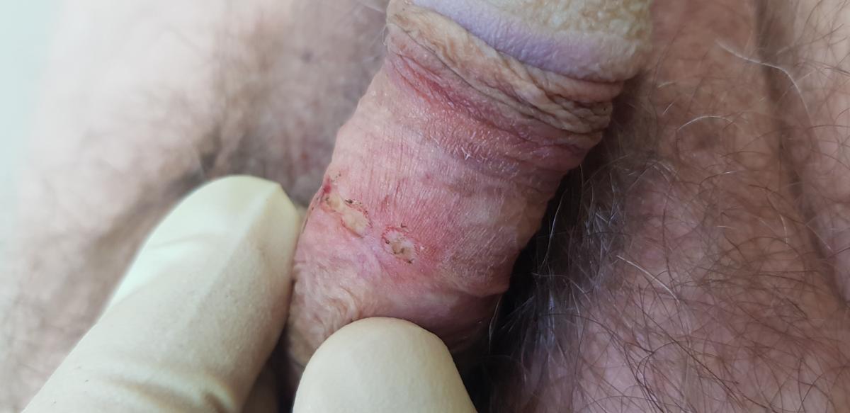 после удаления темных папул после