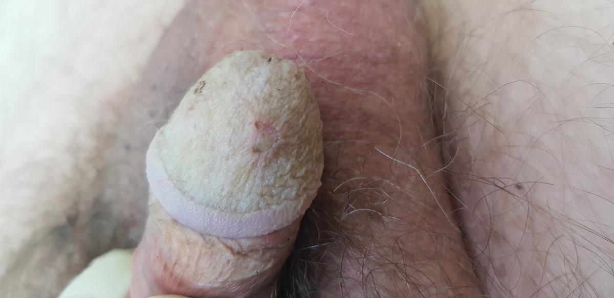 после удаления темных папул после