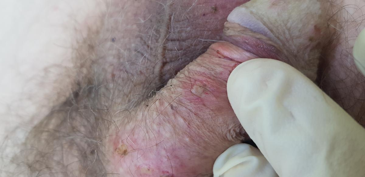 после удаления темных папул После