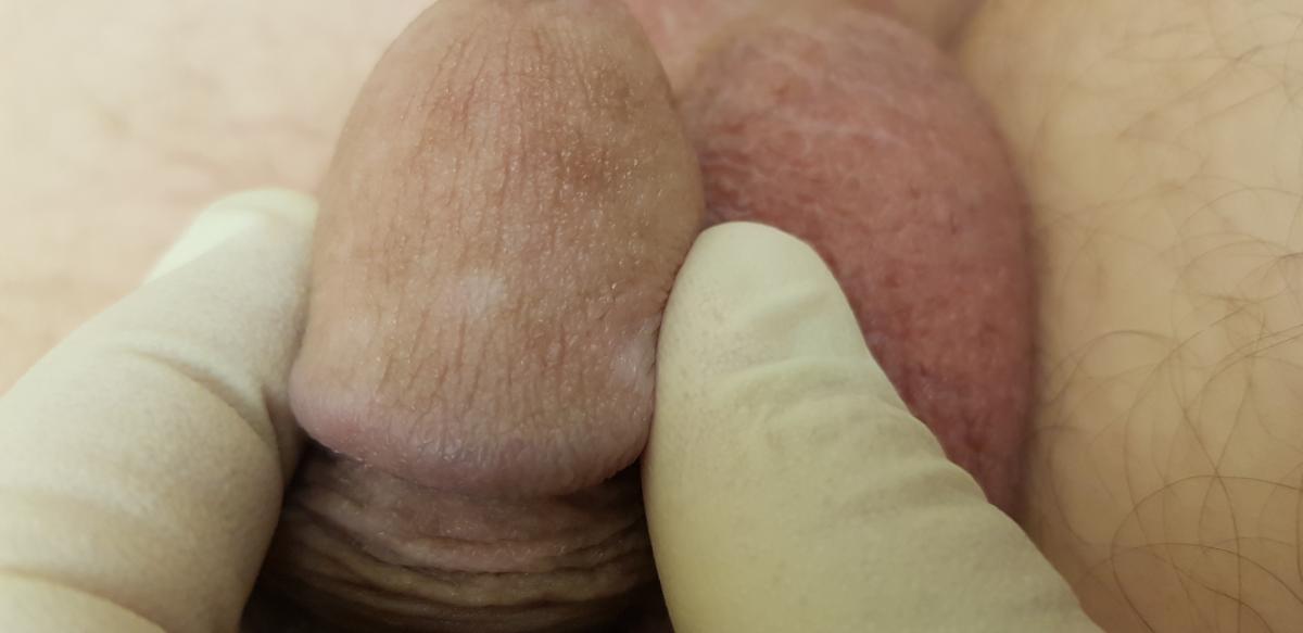 другие пятна на головке пятна другие