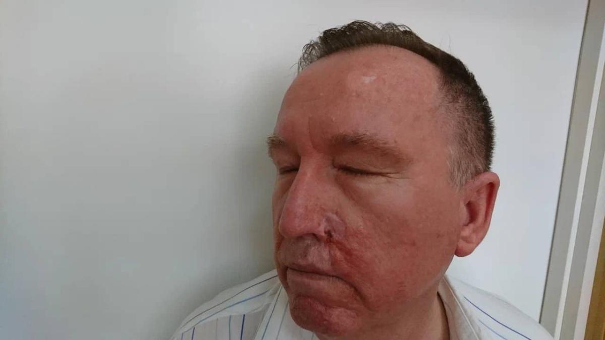 Сифилиды во рту Поздний сифилис в отсутствие терапии